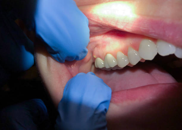 Best Broken or Chipped Tooth Repair in Obion, TN